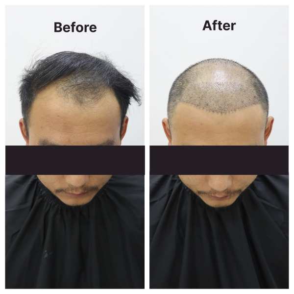 Hair Transplant result KOQ10